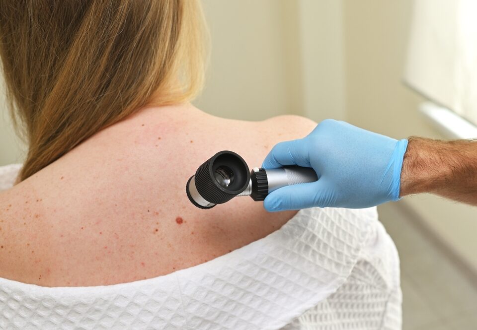 Skin Cancer Awareness: Prevention, Detection, and Treatment Options