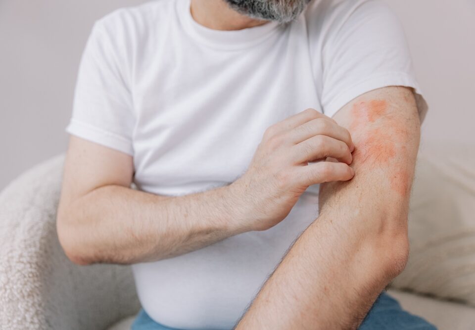 Psoriasis and Eczema: Understanding Chronic Skin Conditions and Treatment Options