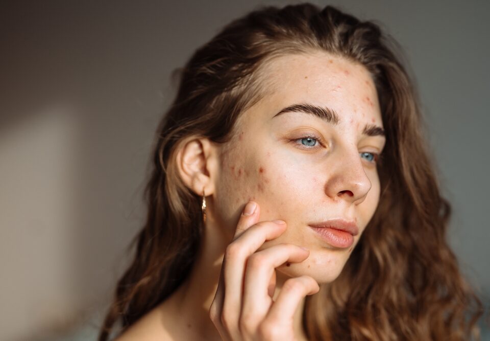 Adult Acne: Why It Happens and When to See a Dermatologist